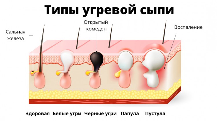 уход за кожей, Ретасол, угри, прищи, акне, ретиноиды