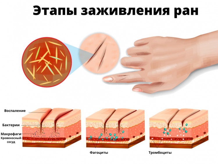 кожа, уход за кожей, заживление кожи, Стизамет, метилурацил